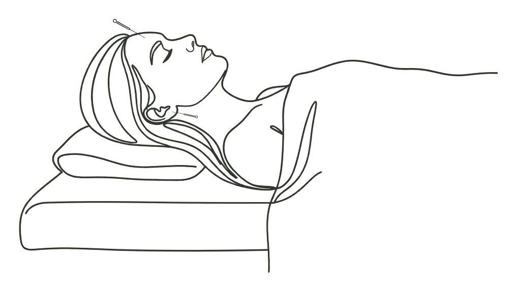 Line drawing of a person lying on the treatment couch with eyes closed, fine needles placed at the hairline and at the ear