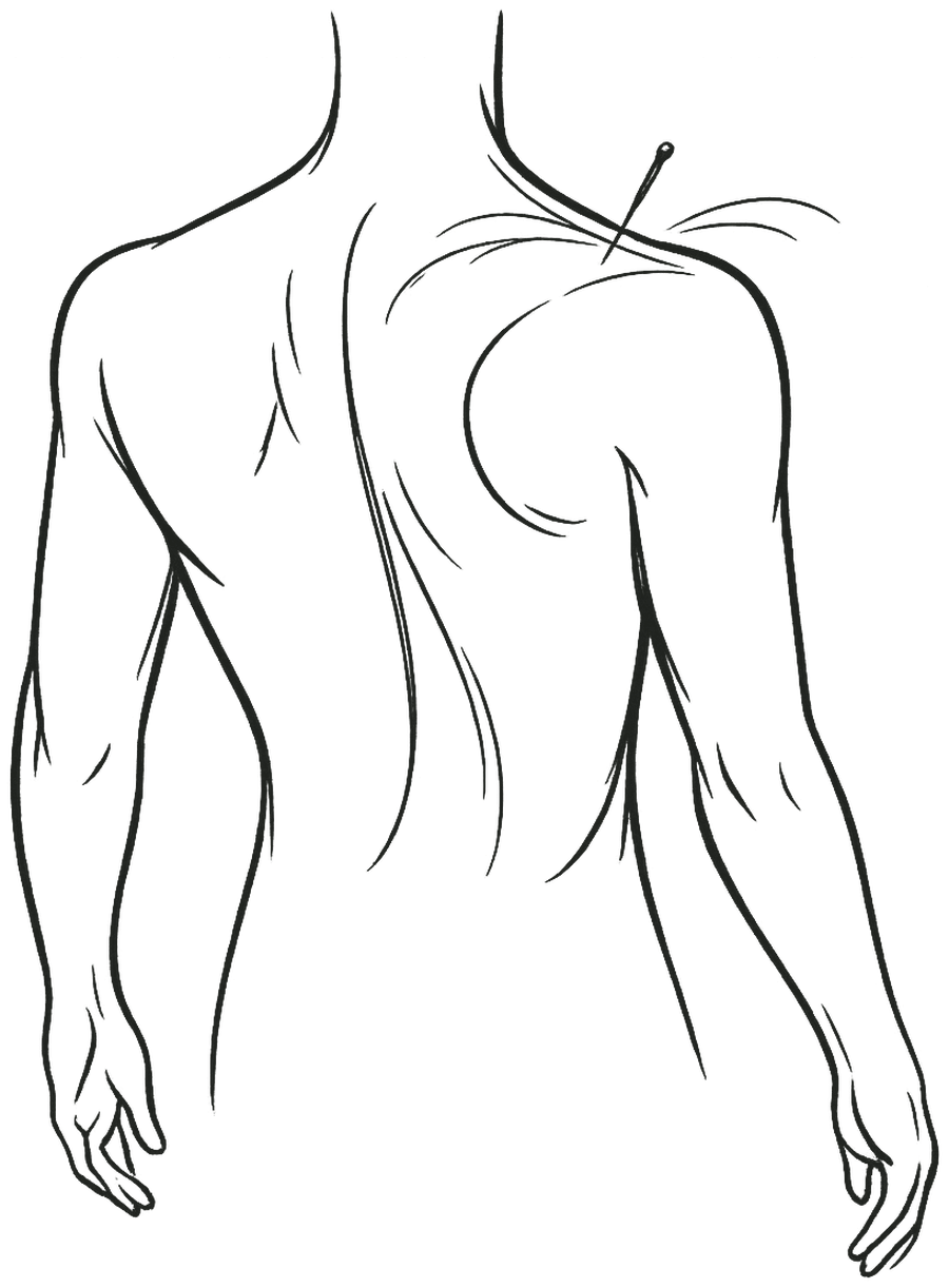 Line drawing of the upper back and shoulders with a single acupuncture needle placed above the shoulder blade, the surrounding fascial lines fanning out from it